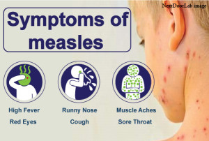 Measles case reported in Guatemala